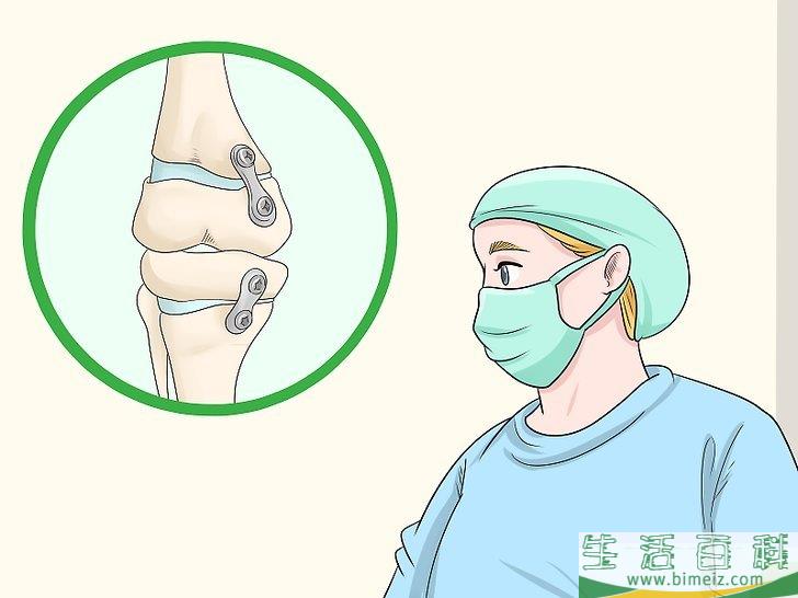 如何矫正膝外翻