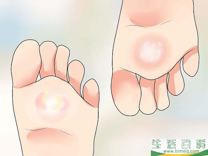 如何辨认是否患上香港脚