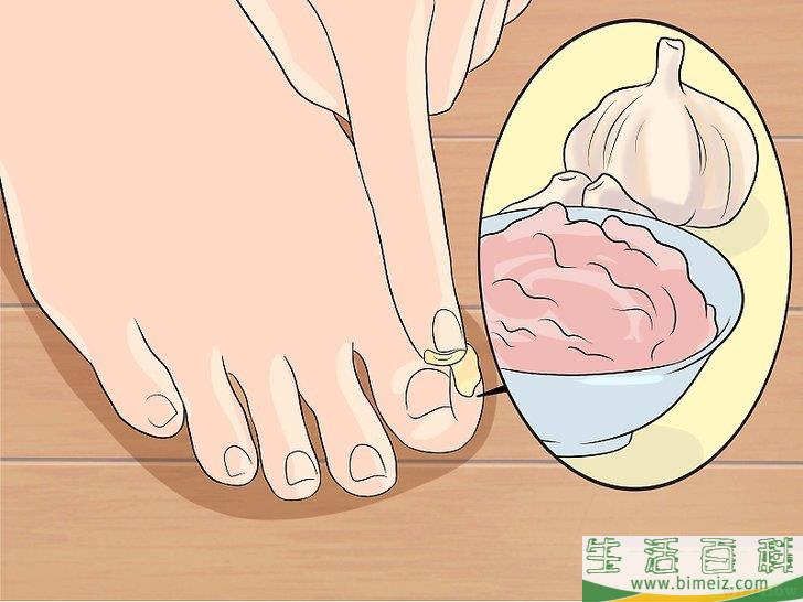 如何治疗脚趾感染