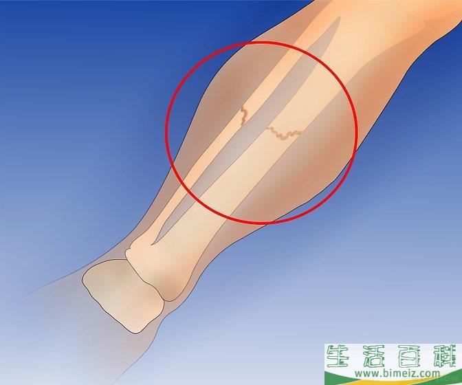 如何预防外胫夹