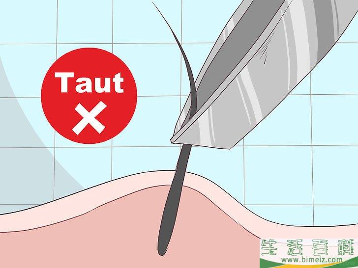 怎么除掉向内生长的阴毛