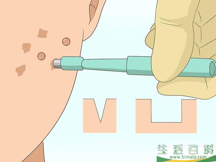 怎么快速祛除痘疤