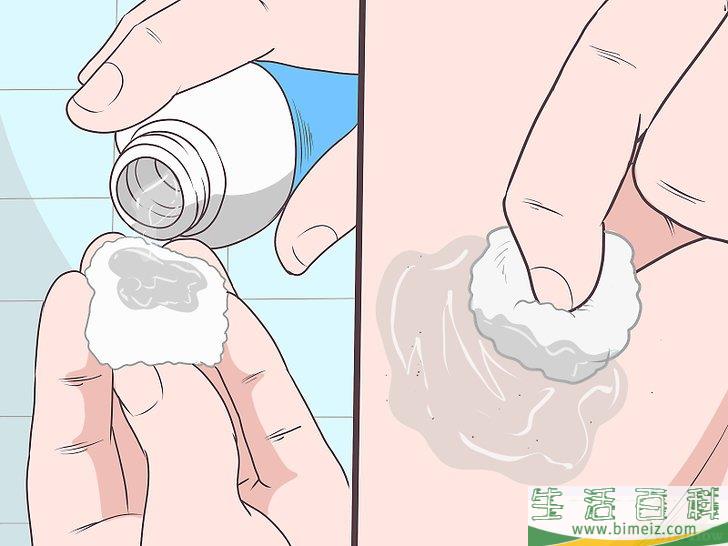 怎么除掉向内生长的阴毛