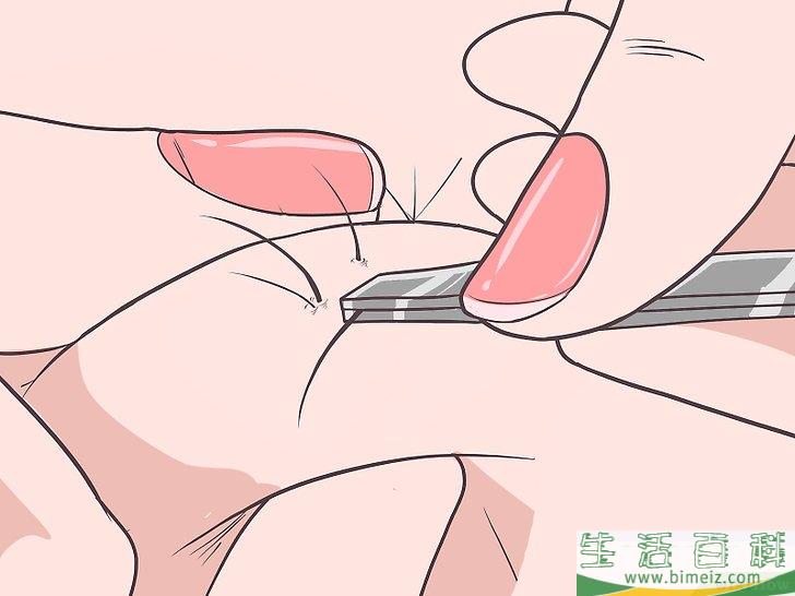 怎么除掉向内生长的阴毛