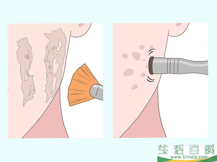 怎么快速祛除痘疤