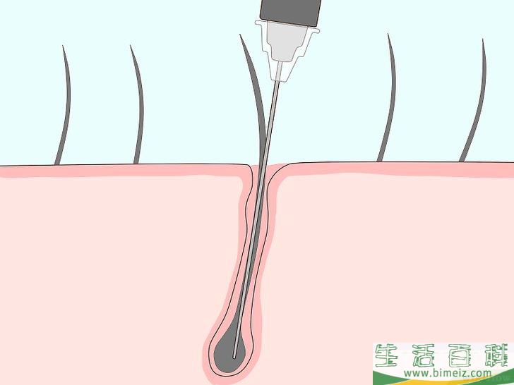 怎么去除腋毛
