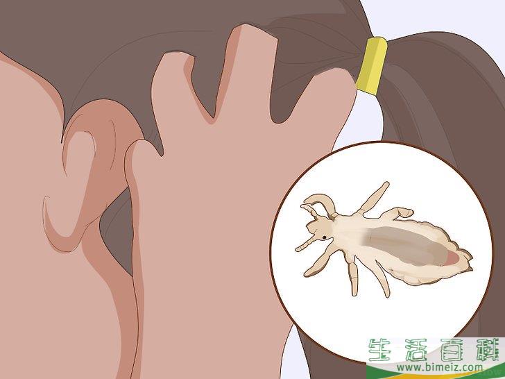 怎么预防虱子