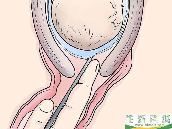 怎么破羊水