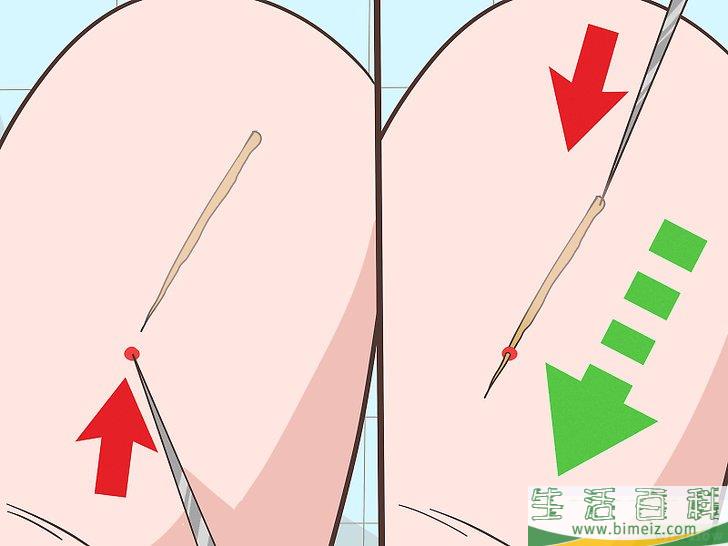 怎么取出扎进皮肤深处的碎屑