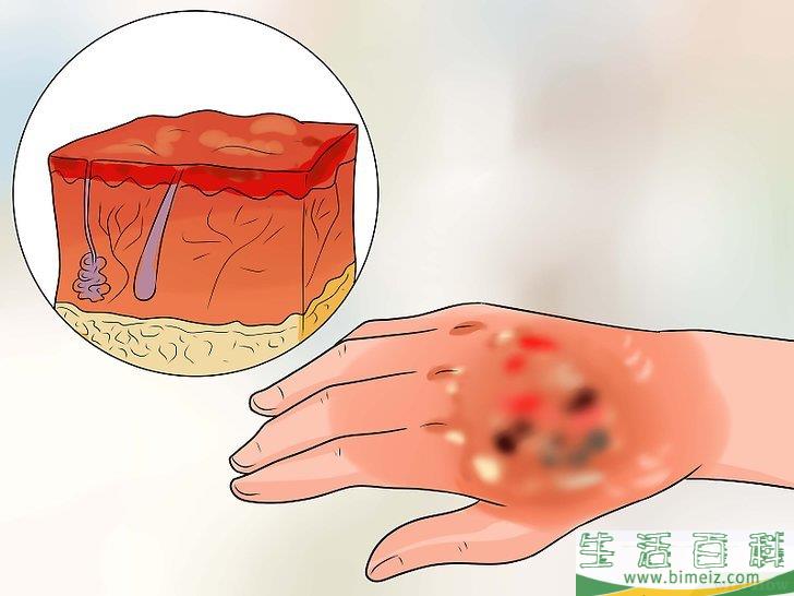 怎么治疗被热水烫伤的皮肤