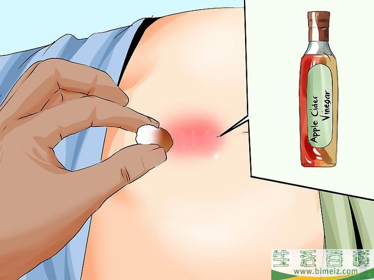 怎么治疗藏毛囊肿