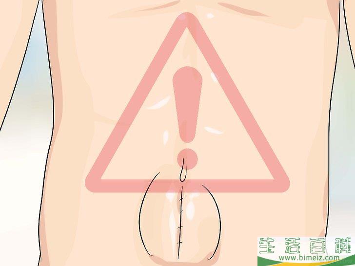 怎么判断自己是否患有疝气