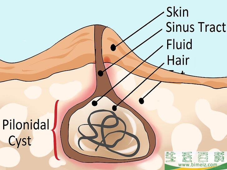 怎么治疗藏毛囊肿