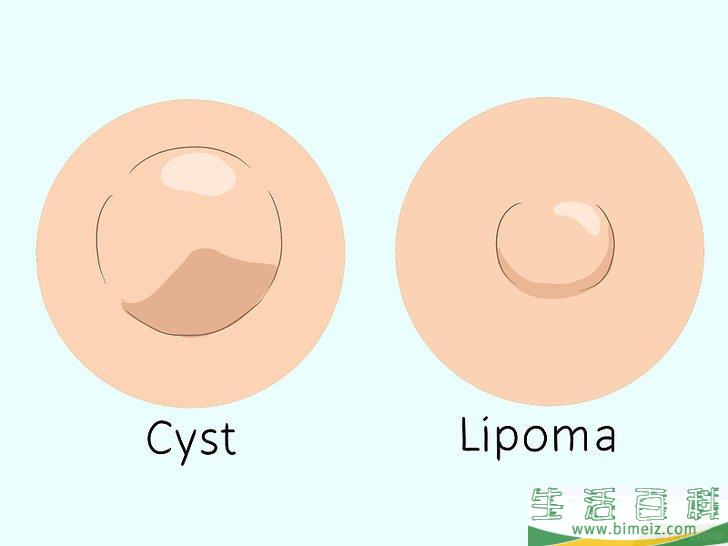 怎么知道自己是否长了脂肪瘤