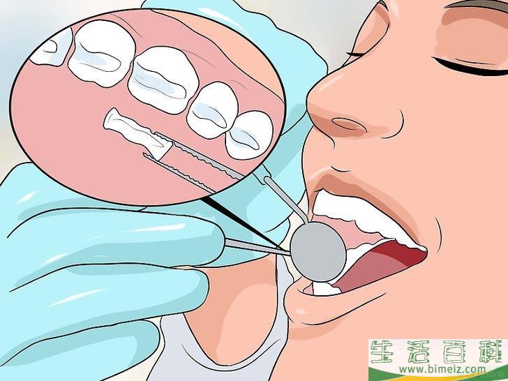 怎么修复牙釉质