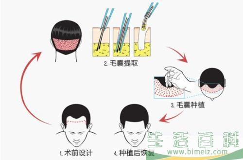 自体毛发种植多少钱 自体毛发种植哪一步最关键