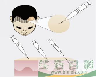 自体毛发种植多少钱 自体毛发种植哪一步最关键