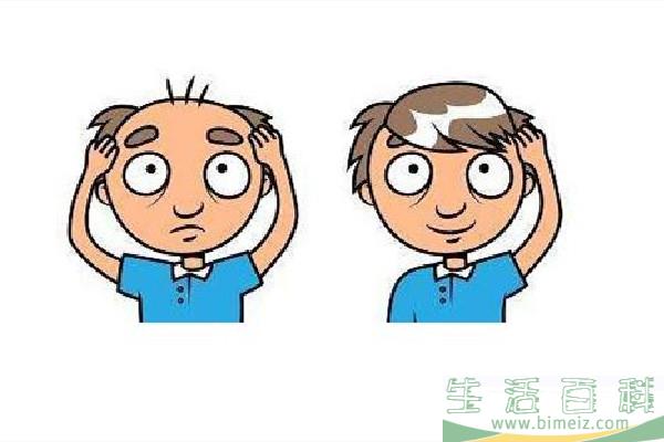植发会不会再次脱落 植发用的是自己的头发吗