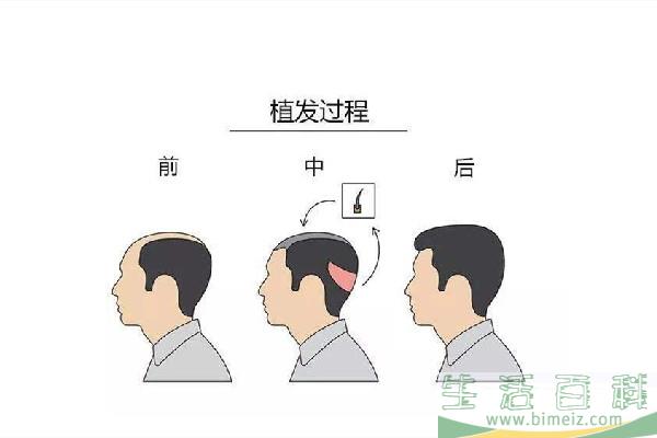 植发需要多少钱 植发按什么标准收费