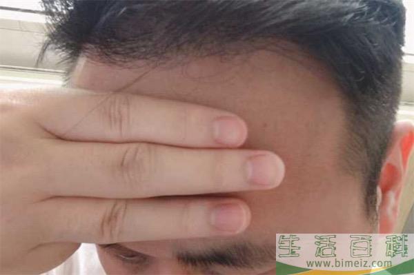正常发际线在哪个位置 发际线太高了怎么挽救