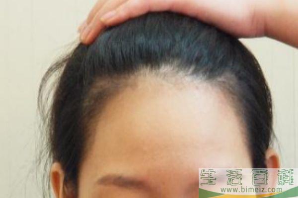 怎么样让发际线变低 如何让发际线前移