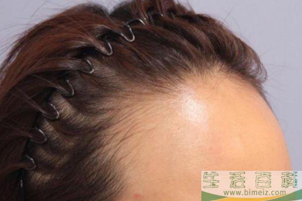 怎么样让发际线变低 如何让发际线前移