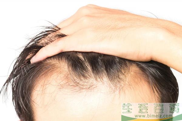 什么是毛发移植 毛发移植安全吗