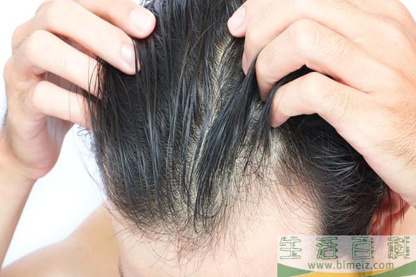 什么是毛发移植 毛发移植安全吗