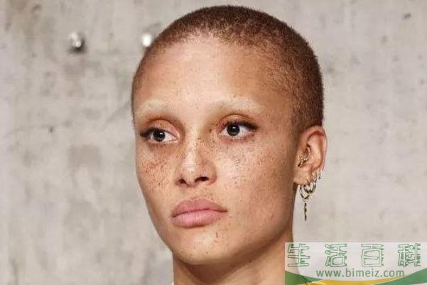 雀斑对身体有影响吗 雀斑可以做光子嫩肤吗