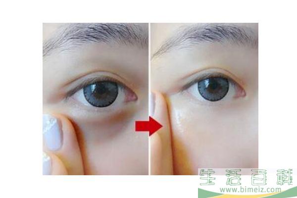 黑眼圈能自己消除吗 黑眼圈手术一般多少钱