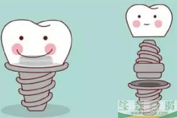 种牙用什么材质的好 种牙有几种材质