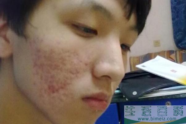 青春痘怎么快速消除 青春痘一般多久会消失
