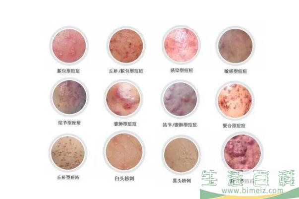 青春痘怎么快速消除 青春痘一般多久会消失
