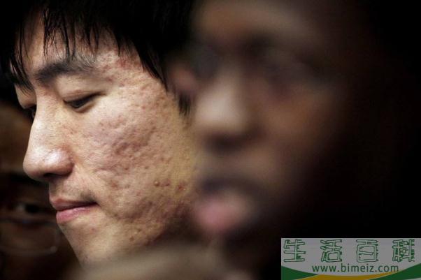 青春痘留下的疤痕怎么才能消除掉 青春痘和痤疮有什么区别