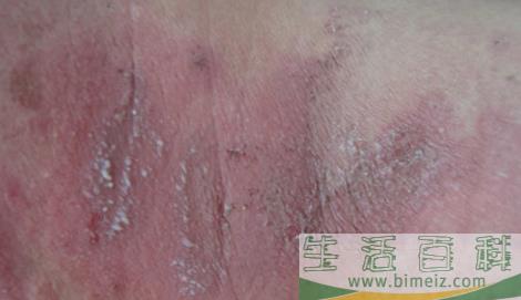 隐翅虫皮炎要脱几层皮3