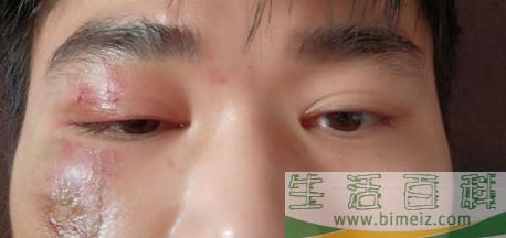 隐翅虫疤痕色素半年还没好2