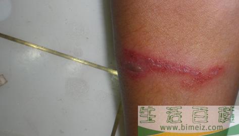 隐翅虫皮炎可以自愈吗2