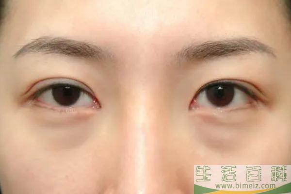 眼袋怎么去除最有效果 眼袋的形成原因