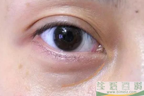 眼袋怎么去除最有效果 眼袋的形成原因