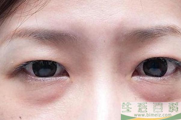 眼袋怎么去除最有效果 眼袋的形成原因