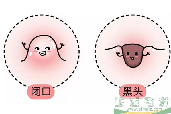 闭口长啥样 闭口怎么除