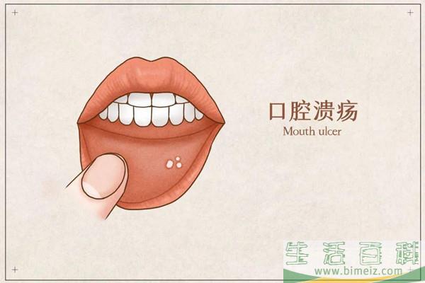 口腔溃疡吃什么药好 口腔溃疡吃什么维生素