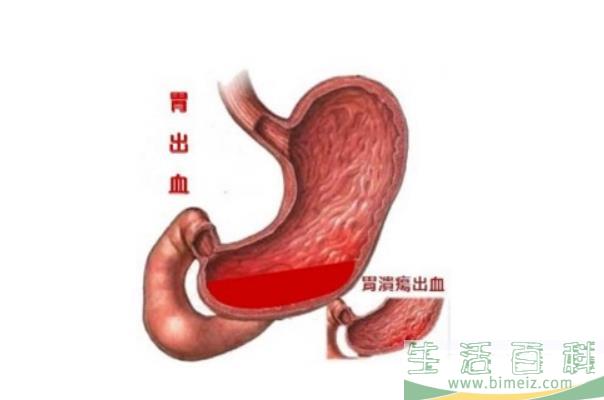 胃出血有什么症状表现 胃出血后吃什么补血又养胃