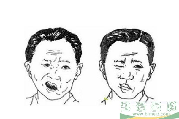 面瘫怎么治疗 面瘫怎么治疗好得快
