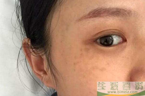妊娠斑怎么才能祛除 妊娠斑产后多久能消失