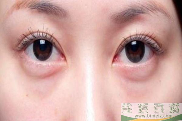 眼袋出现的原因 韩式去眼袋有效果吗 