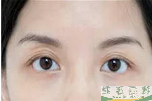 韩式去眼袋第二天会肿吗 韩式去眼袋的注意事项