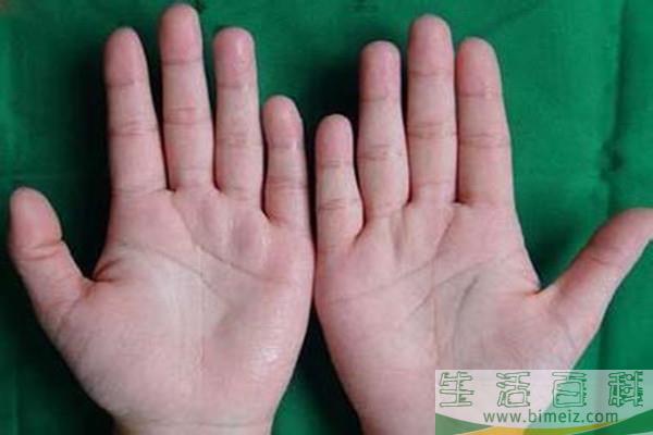 手汗症能自愈吗 手汗症太严重怎么办