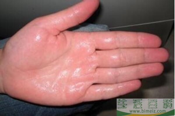 手汗症怎样能缓解呢 手汗症能用中医调理吗