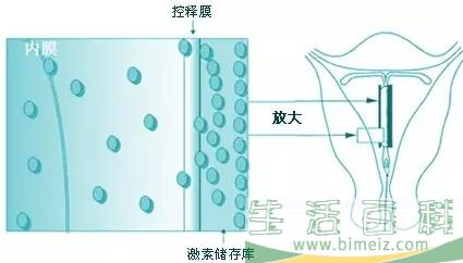 曼月乐环能够治疗哪些疾病 曼月乐环的作用与功效